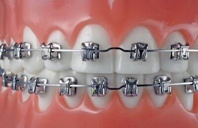 成人牙齿矫正要多久?