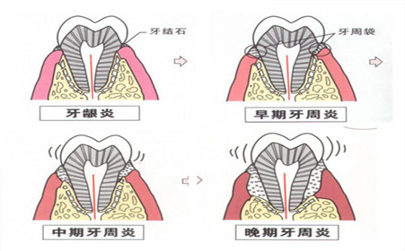 牙周炎和牙龈炎的区别？
