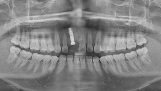 卢勇辉拔除即刻种植