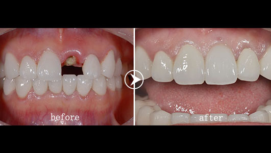 卢勇辉拔除即刻种植