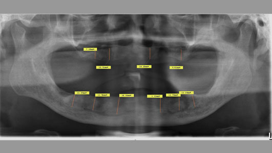 代堂华种植覆盖义齿修复案例