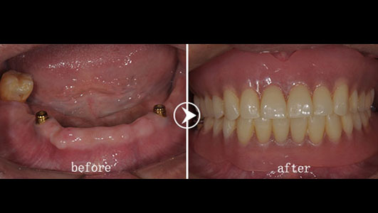 代堂华种植覆盖义齿修复案例