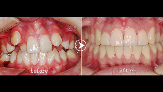 杜艺平金属自锁正畸