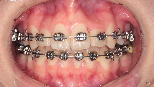 杜艺平金属自锁正畸