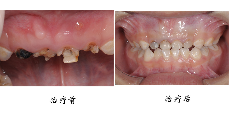 王冉儿牙根管治疗