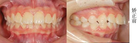 矫正前牙齿情况