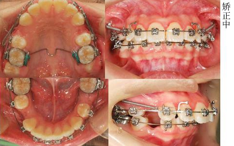 矫正中牙齿情况