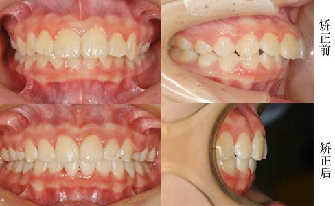 牙齿矫正前后对比图