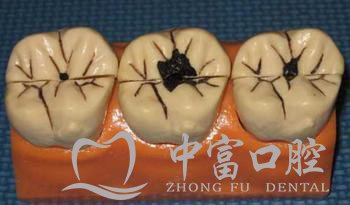 漳州儿童龋齿的危害有哪些