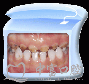 漳州儿童蛀牙的原因有哪些