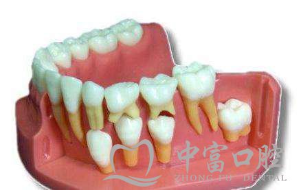 儿童替牙期牙齿不齐是什么回事?