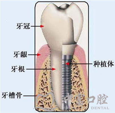 种植牙要怎么选?