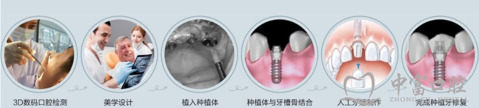 种植牙要怎么选?