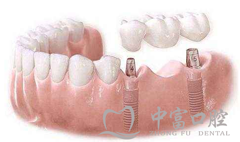 种植牙要怎么选?