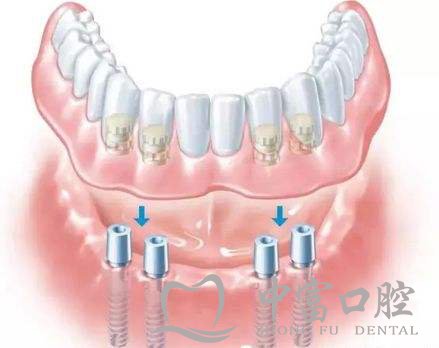 缺牙种牙还是镶牙好