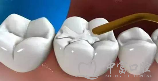 补牙后哪些情况是正常现象，哪些情况是需要复诊？