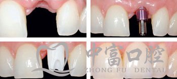 门牙缺失怎么办