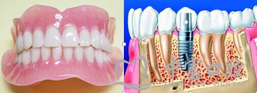 糖尿病人可以做种植牙么?