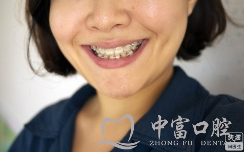 成人龅牙矫正得多少钱