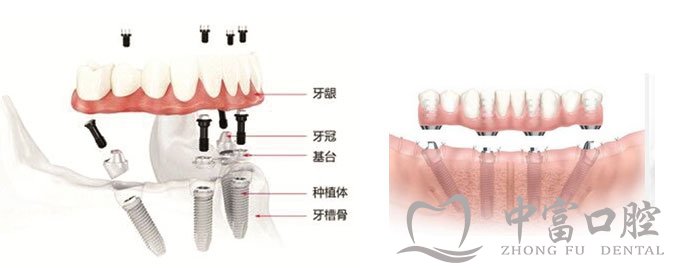 半口种植牙修复要多长时间