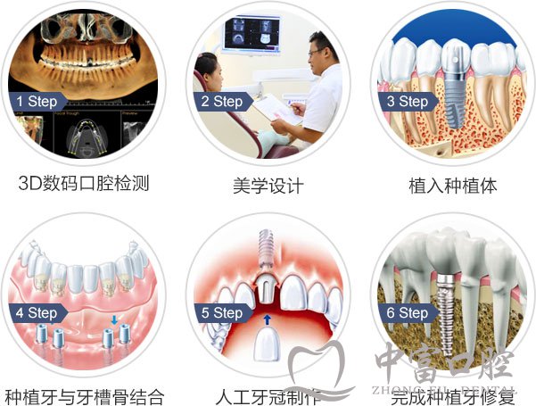半口种植适合哪些牙齿缺失的人