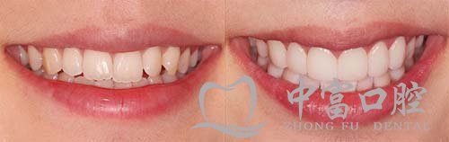 假牙篇：你的假牙过期了吗？