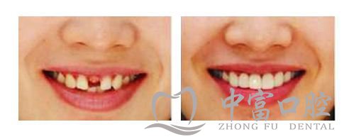 补牙多少钱一颗?有什么注意事项