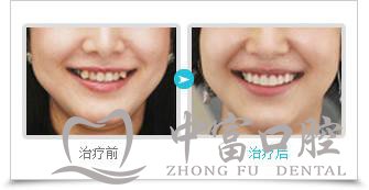 虎牙矫正前后效果对比图