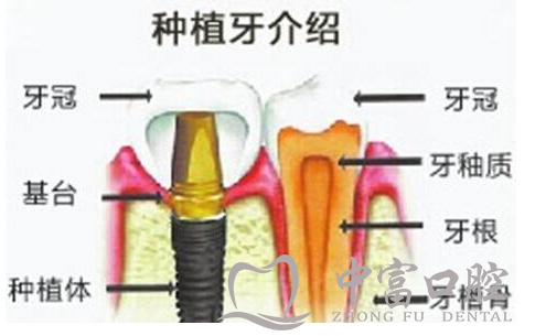 种植牙与烤瓷牙的区别在哪里？