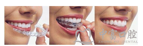 牙齿矫正真的会反弹吗?