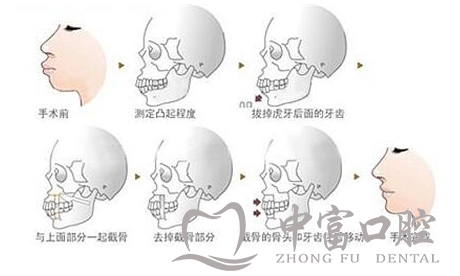 牙齿矫正真的能改变脸型吗？