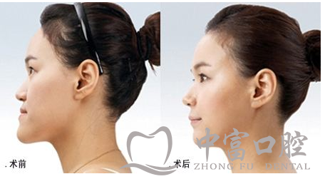 牙齿矫正真的能改变脸型吗？