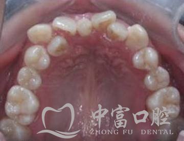 同样是做牙齿矫正, 为什么我要拔牙!