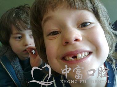 单颗门牙缺失牙的烦恼？