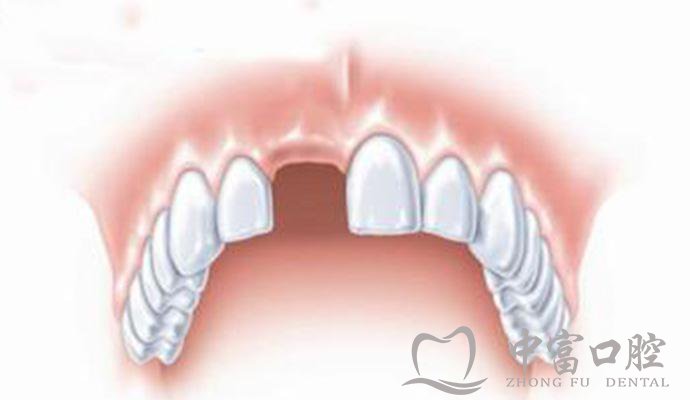 门牙缺失怎么补才好呢？
