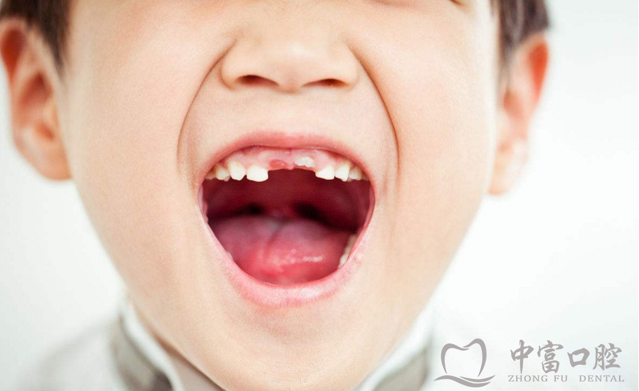 儿童门牙缺失？